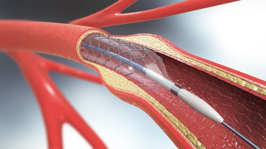 India Coronary Stent Industry