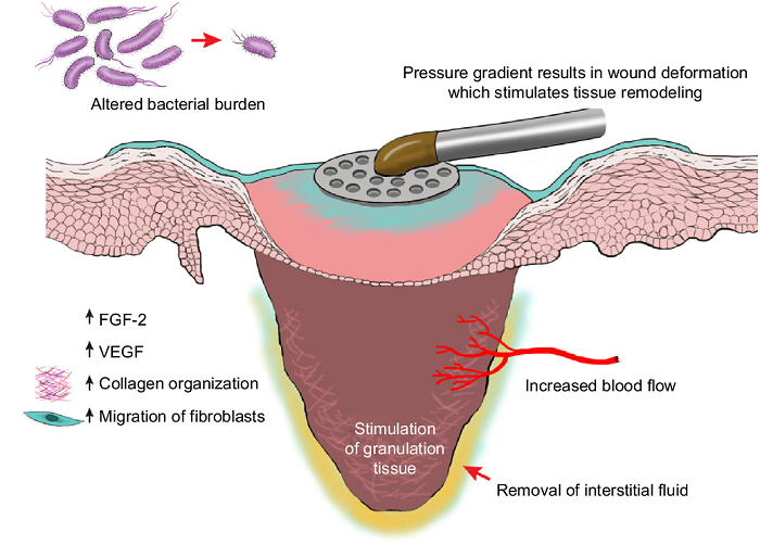 Negative Pressure Wound Therapy Industry