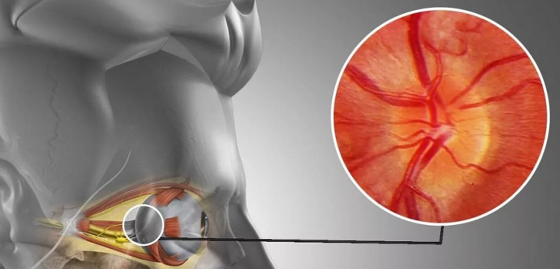 Optic Neuropathy Management Market