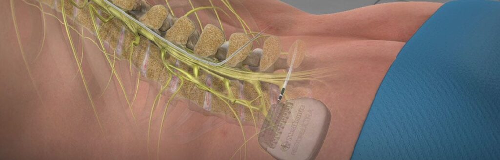 Spinal Cord Stimulators Market