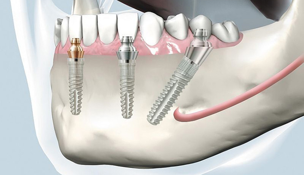 Supramalleolar Osteotomy Implants Market
