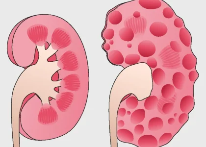 Global Autosomal Dominant Polycystic Kidney Disease Treatment Industry