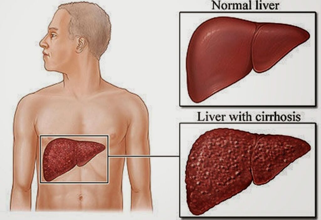 Cirrhosis Management Market