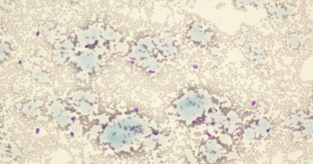 Global Cryoglobulinemia Treatment Industry