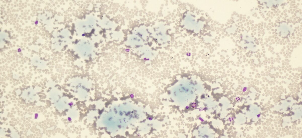 Global Cryoglobulinemia Treatment Industry