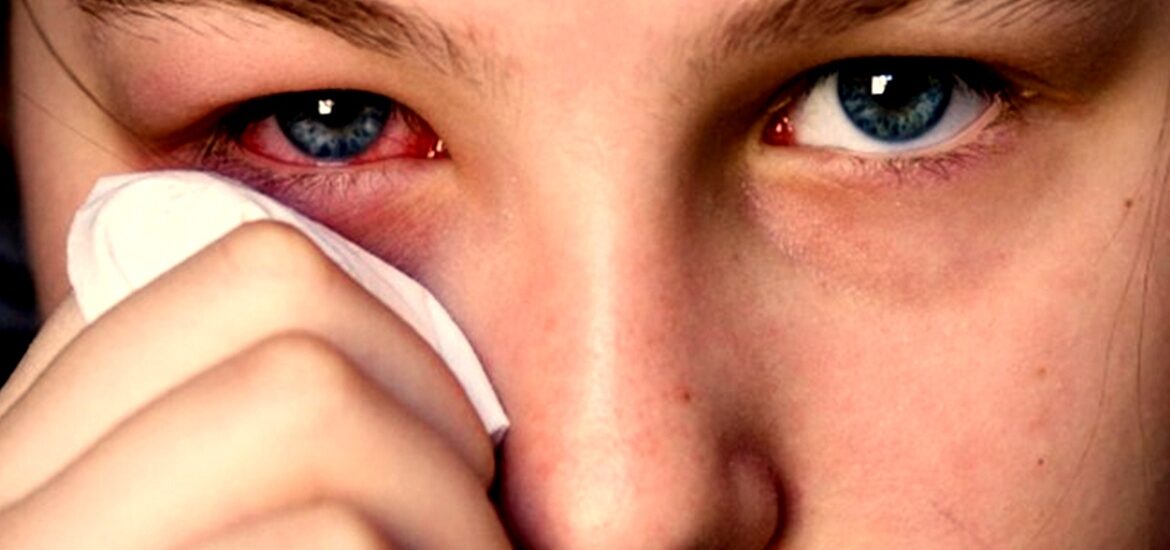 Global Eye Infections Treatment Industry