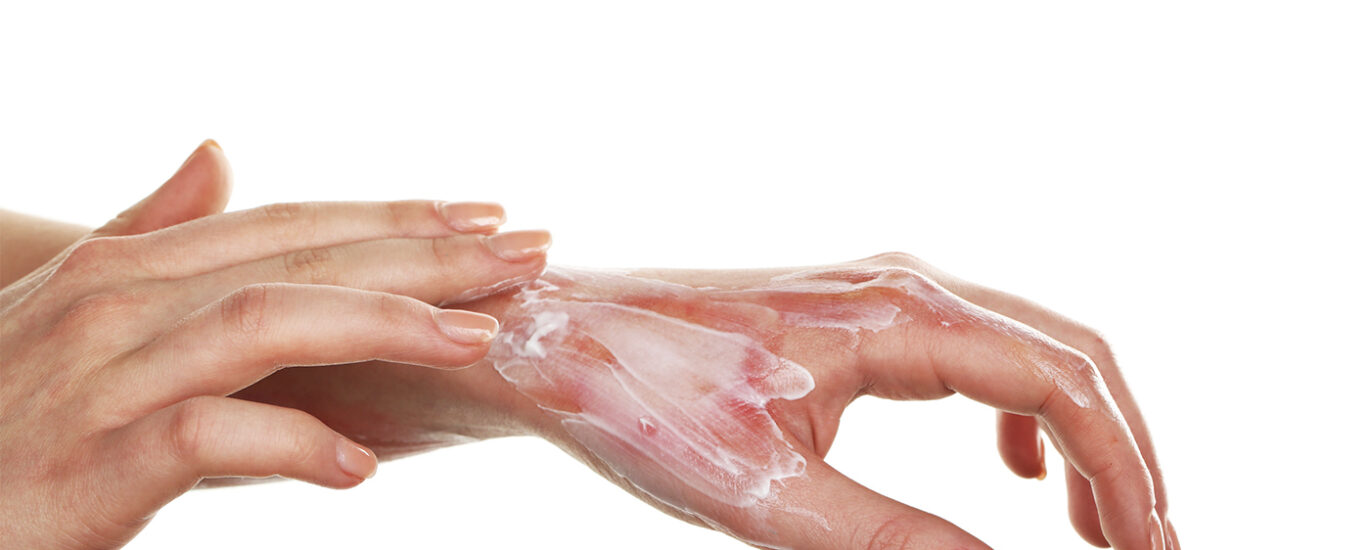 Global Burns Treatment Market
