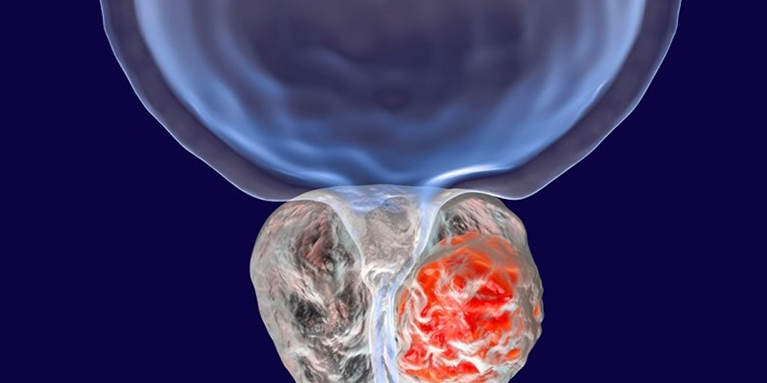 Global Hormone Sensitive Advanced Prostate Cancer Treatment Industry