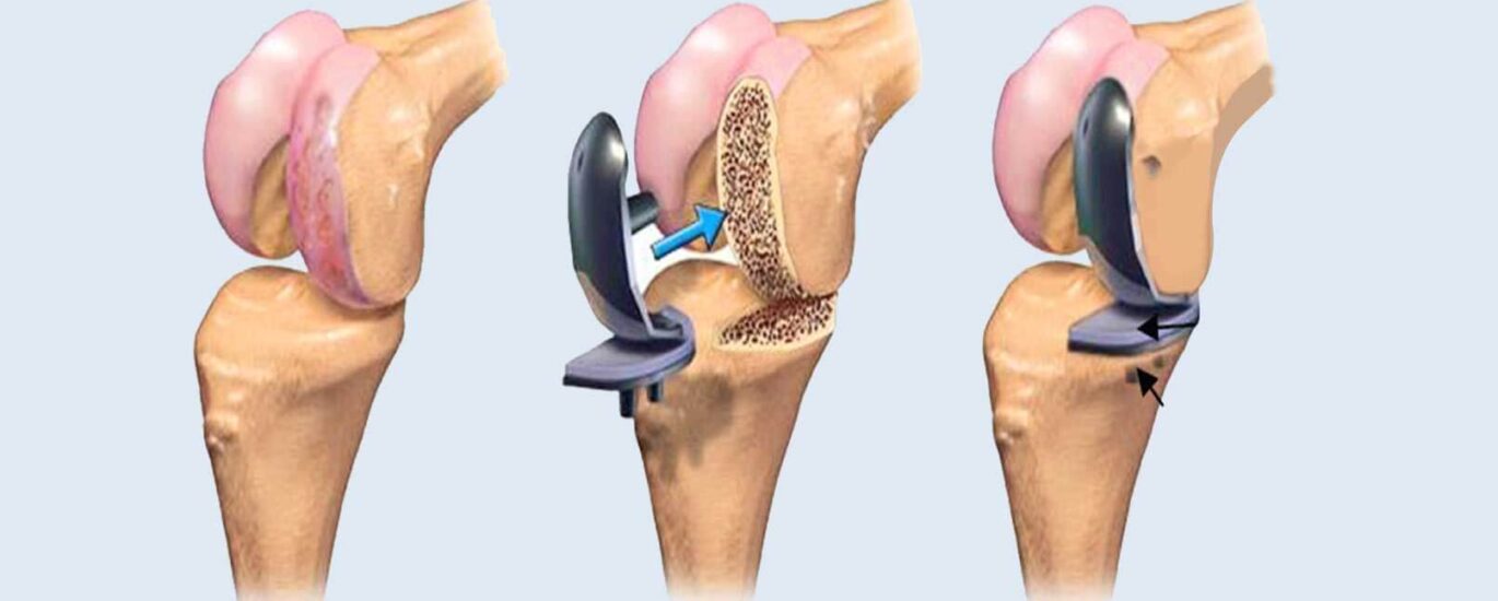 Global Joint Reconstruction Devices Industry