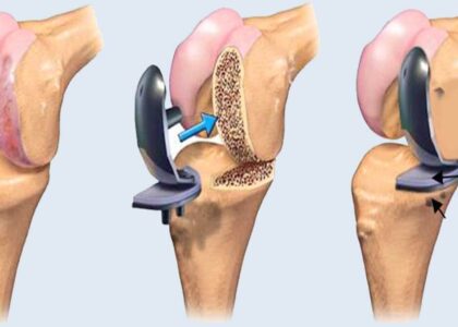 Global Joint Reconstruction Devices Industry