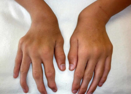 Global Mucopolysaccharidosis (MPS) Treatment Industry