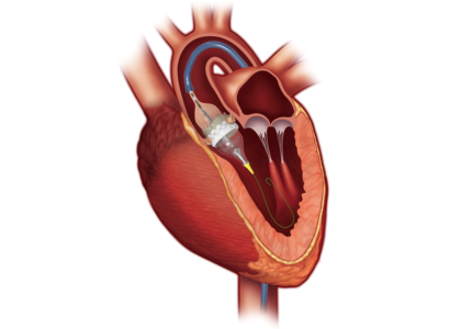Global Transcatheter Heart Valve Replacement Industry