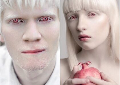 Global Hermansky Pudlak Syndrome Therapeutics Industry