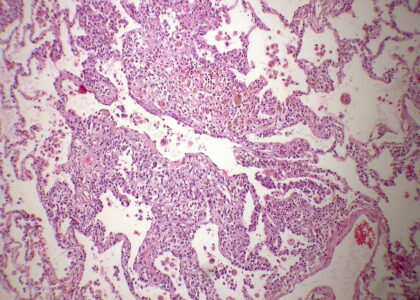 Global Langerhans Cell Histiocytosis Management Industry
