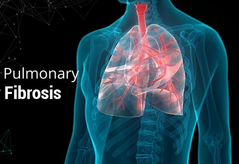 Global Progressive Pulmonary Fibrosis Treatment Industry