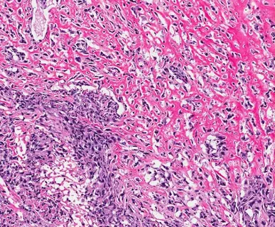 Rosai-Dorfman Disease Therapeutics Market