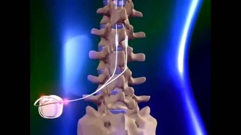 Spinal Cord Stimulators Market