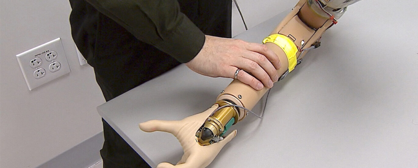 Upper Limb Prosthetics Market