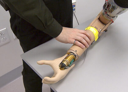 Upper Limb Prosthetics Market