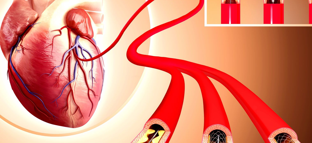 Global Coronary Stents Industry