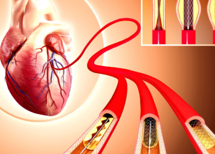 Global Coronary Stents Industry