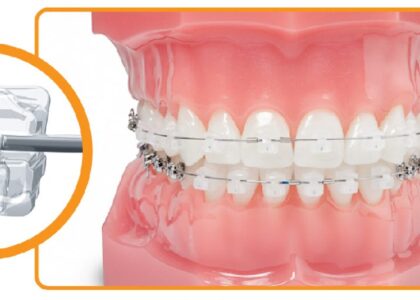 Global Dental Orthodontic Wax Industry