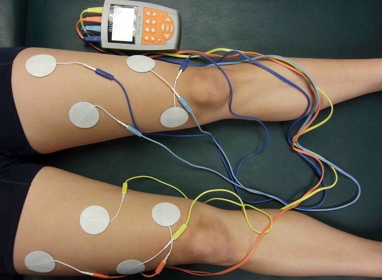 Global Functional Electrical Stimulation Industry