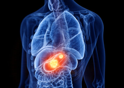 Global HER2 Positive Gastric Cancer Industry