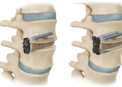 Global Non Fusion Spinal Devices Industry