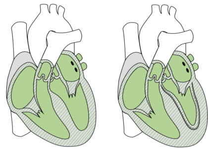 Global Restrictive Cardiomyopathy Treatment Industry