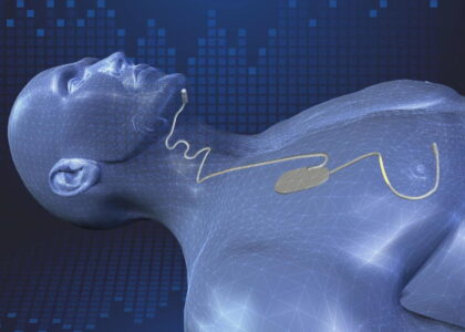 Global Sleep Apnea Implants Industry