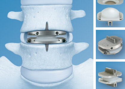 Global Vertebroplasty and Kyphoplasty Devices Industry