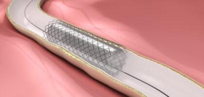 Peripheral Vascular Stent Market