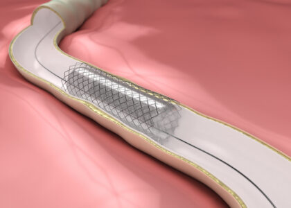 Peripheral Vascular Stent Market
