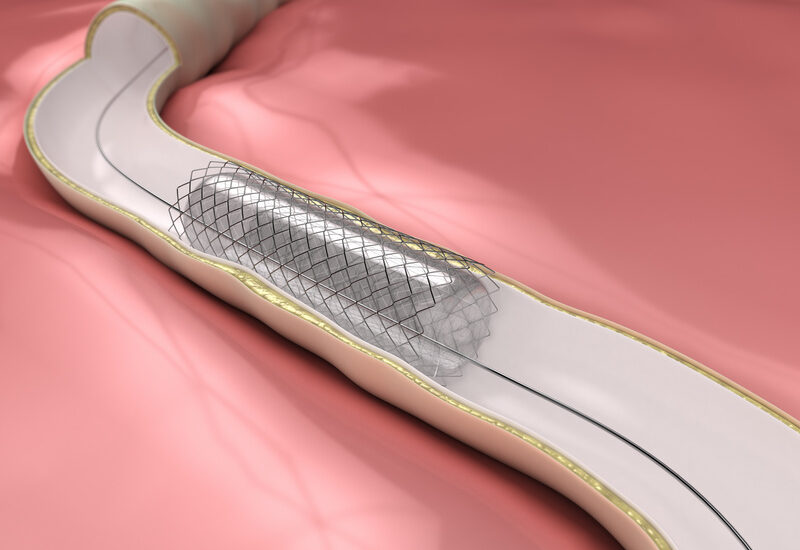 Peripheral Vascular Stent Market