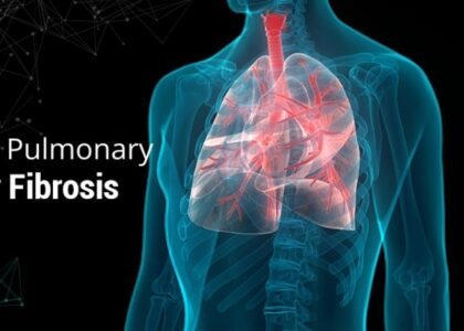 Global Progressive Pulmonary Fibrosis Treatment Industry