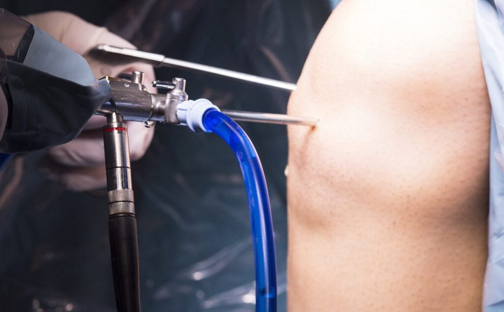 arthroscopy procedures and products market