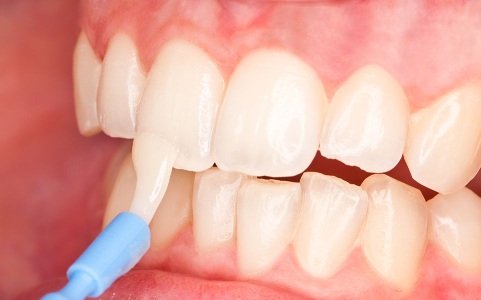 Global Dental Fluoride Varnish Market Continues Upward Trajectory