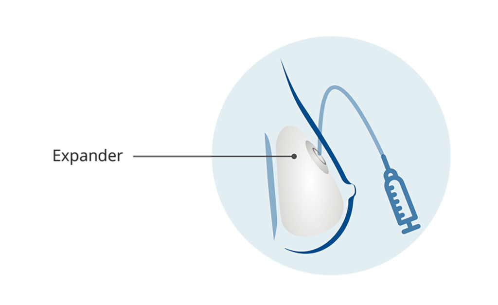Extremity Tissue Expanders Market