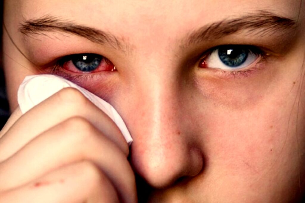 Global Eye Infections Treatment Industry