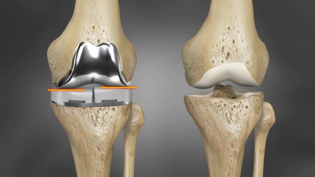 Global 3D Printed Hip and Knee Implants Market