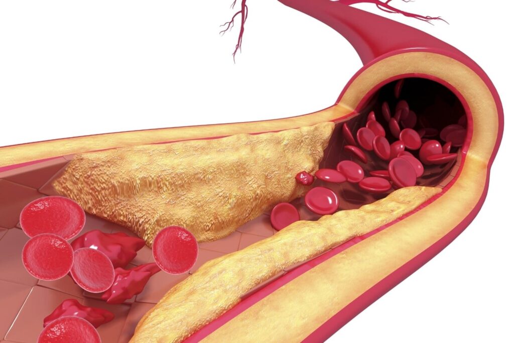 Atherosclerosis Market