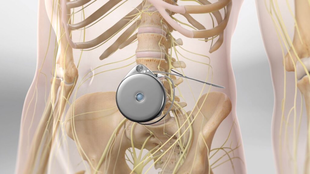 Global Intrathecal Pumps Market