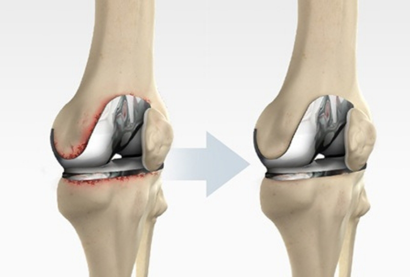 Global Knee Replacement Market