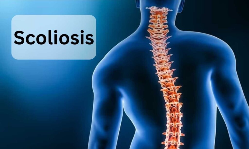 Global Scoliosis Management Industry