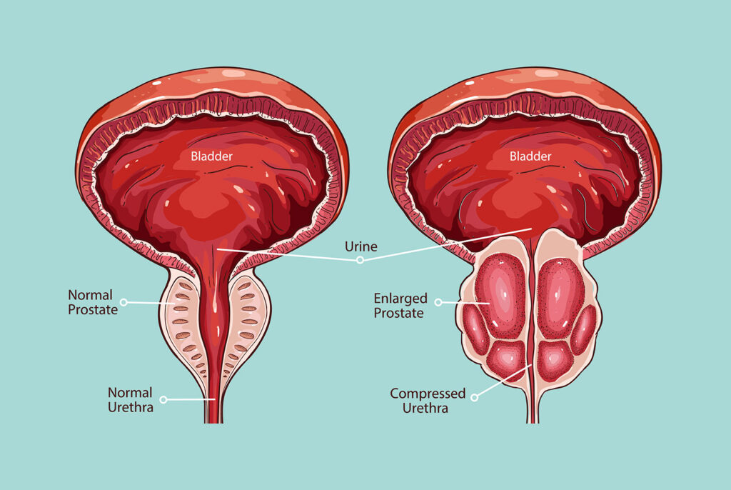 Hormone Sensitive Prostate Cancer Market