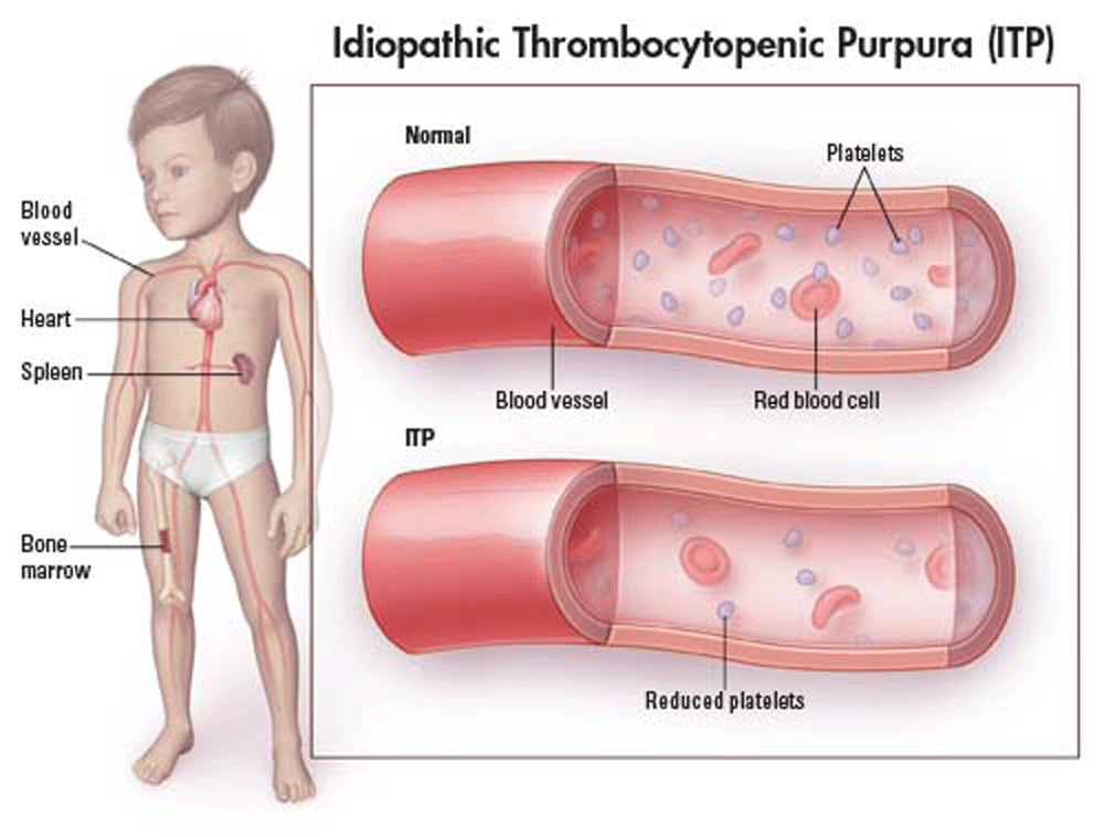 Idiopathic Thrombocytopenic Purpura Therapeutics Market
