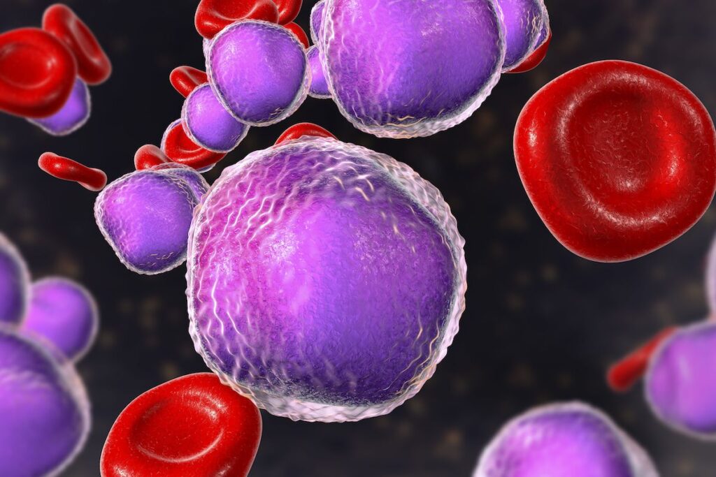 Global Large Granular Lymphocytic Leukemia Therapeutics Industry