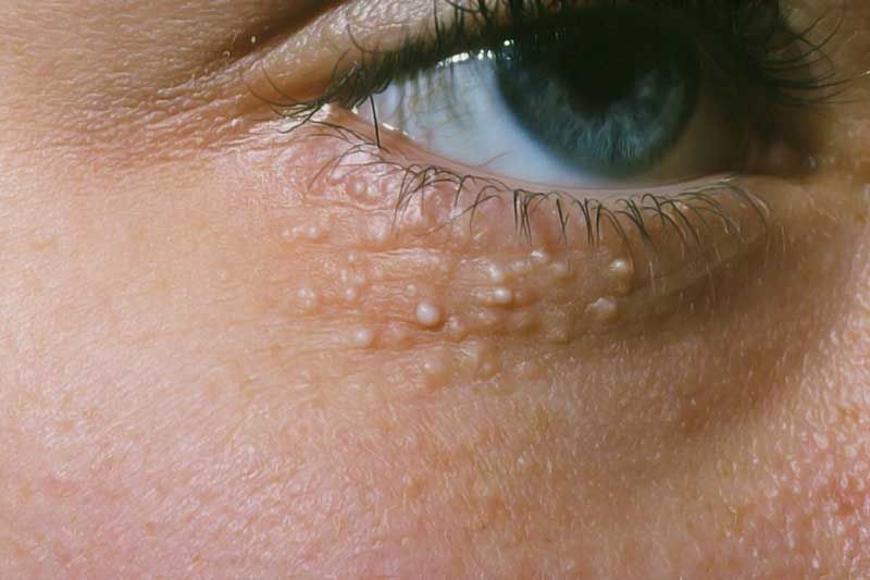 Molluscum Contagiosum Treatment Market