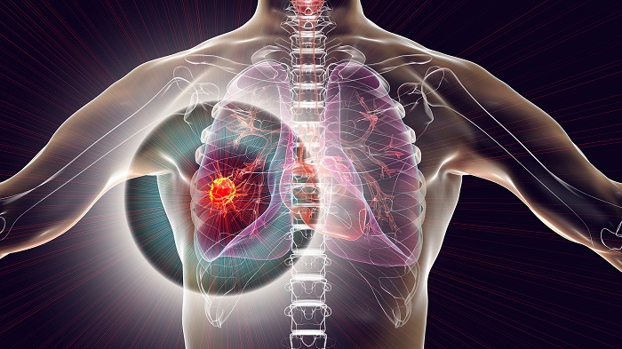 Non-Small Cell Lung Cancer Market